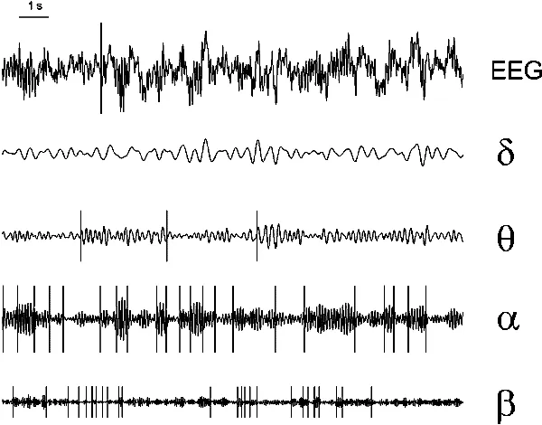 TBI:   NEUROFEEDBACK IMPROVES THE BRAIN